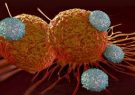 سـرطان سـینه  شایع‌ترین سرطان در بین زنان نیشابور
